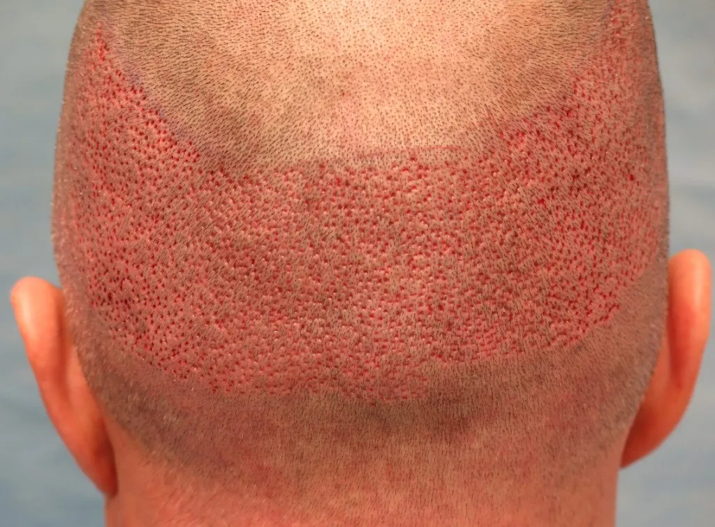 FUE transplant example