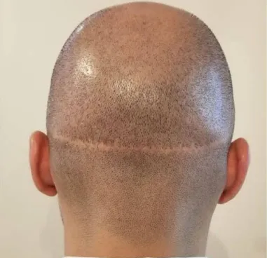 FUT transplant example with linear scarring